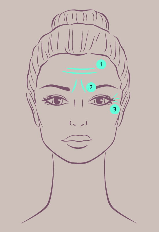 Eine Skizze für eine Botox-Behandlung beinhaltet die Darstellung der zu behandelnden Bereiche im Gesicht, Stirnfalten, Zornesfalten und Krähenfüße
